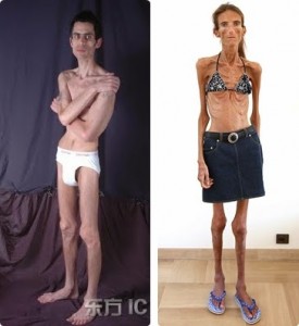 bulimia, anoreksja, ortoreksja